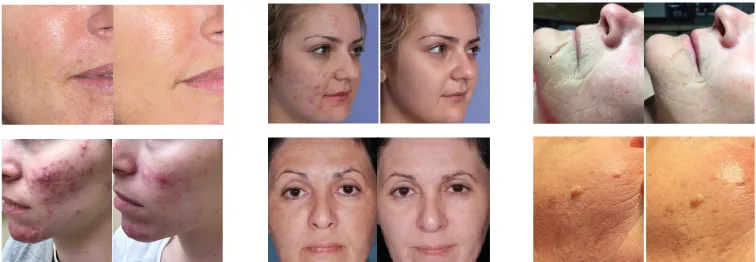 نور مادون قرمز LED Therapy PDT LED Professionele Machine Bio Photomodulation نور فوتوتراپی LED 4